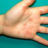 Кожная сыпь у ребенка: коронавирус или просто аллергия?