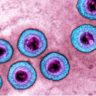В развитии слабоумия вероятно виноваты вирусы герпеса