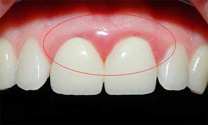 Плохое состояние зубов и десен грозит развитием слабоумия