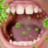 Ученые описали изменения слизистой оболочки рта при COVID-19
