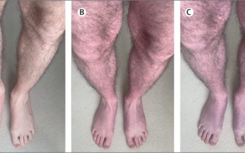Исследование: COVID-19 может изменить цвет ног у мужчин